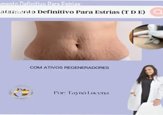 Tratamento Definitivo Para Estrias de Tayna de Lucena Silva – aplicação prática na carreira estética