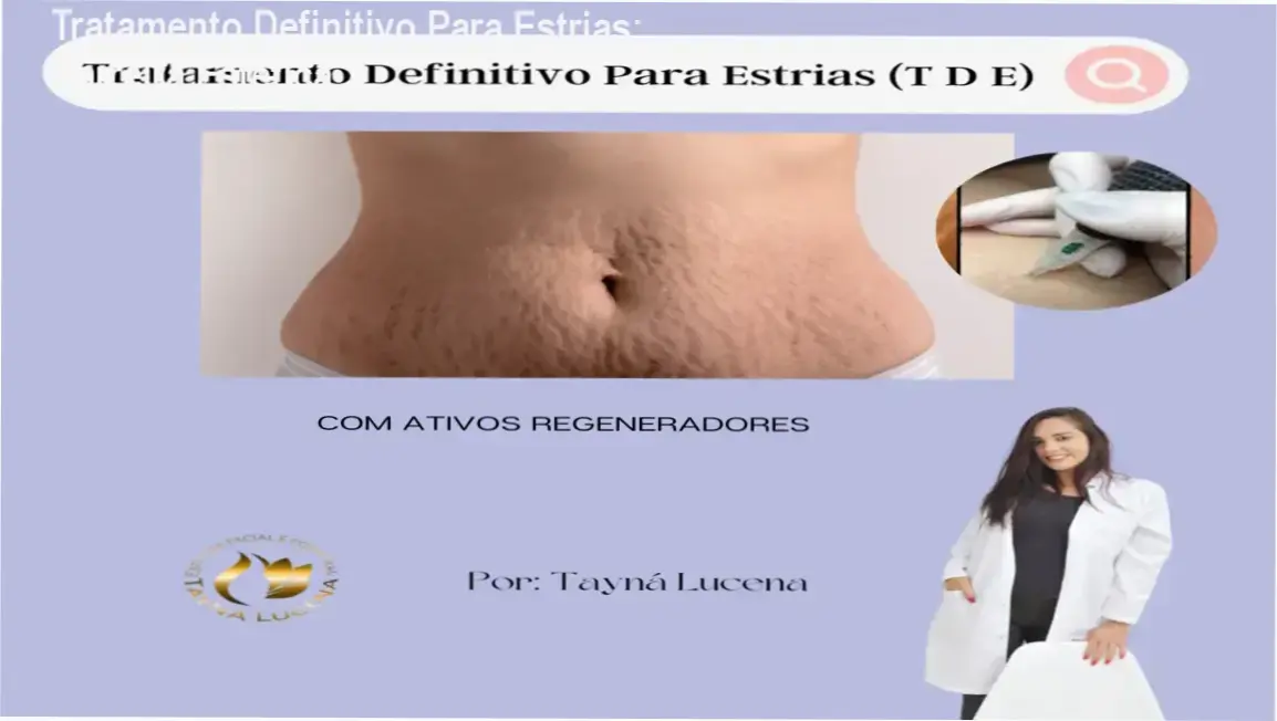 Tratamento Definitivo Para Estrias de Tayna de Lucena Silva – aplicação prática na carreira estética